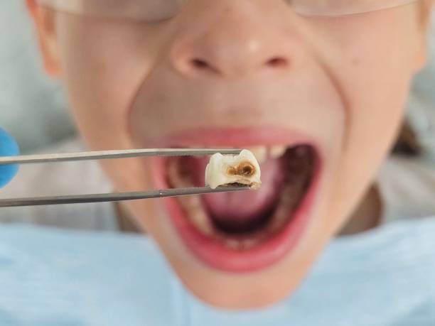 Best Emergency Dental Care for Broken or Chipped Teeth in Hanna City, IL