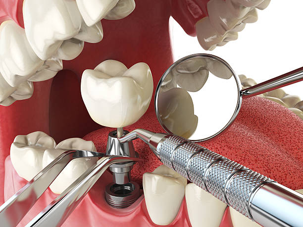 Best Emergency Denture Repair in Hanna City, IL